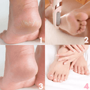 Removedor de Calos e Rachaduras dos Pés